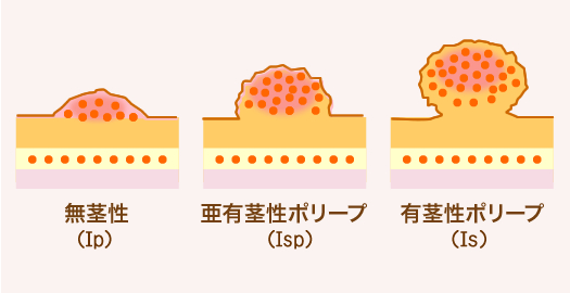 隆起型（Ⅰ型）