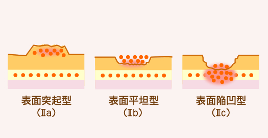 表面型（Ⅱ型）