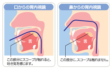 吐き気・苦痛が少ない